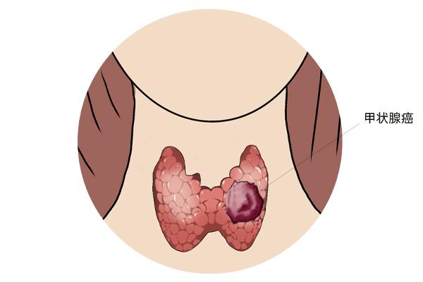 甲狀腺癌癥的主要癥狀表現(xiàn)有什么？為什么會(huì)得甲狀腺癌癥呢？