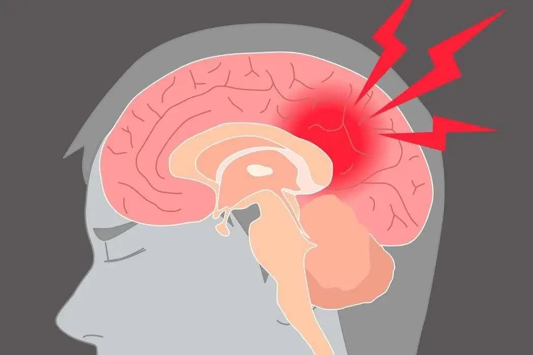 預(yù)防腦梗從習(xí)慣做起，這三大壞習(xí)慣，有的趕緊改正！